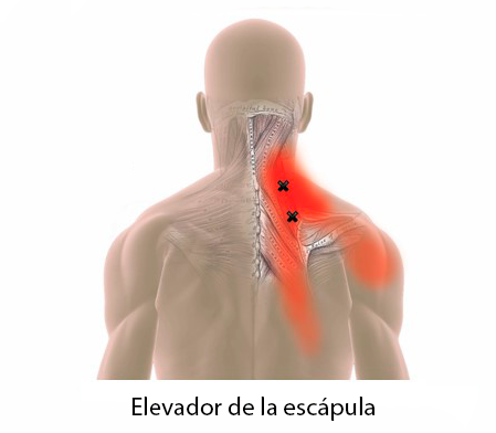 Dolor en el músculo elevador de la escápula
