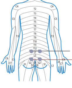 TENS - placement des électrodes TENS en cas de douleurs des vertèbres  lombaires 