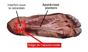 Fig. 2 : dissection cadavérique : aponévrose plantaire