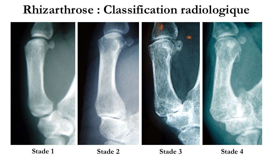 Classification radiologique rhizarthrose