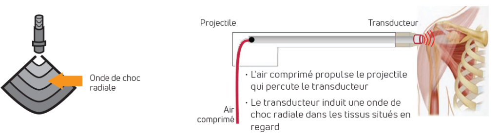 fonctionnement des ondes de choc thérapeutiques