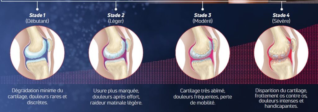 stades de l'arthrose