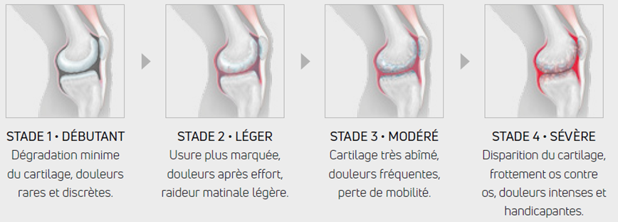 Les 4 stades de la Gonarthrose