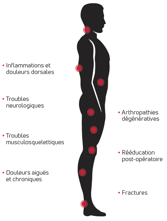 Indications de la TECAR thérapie