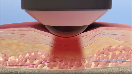 Photobiomodulation Therapy Comes of Age