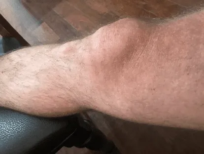 Reflection on &ldquo;Actively&rdquo; Rehabbing after Medial Meniscectomy