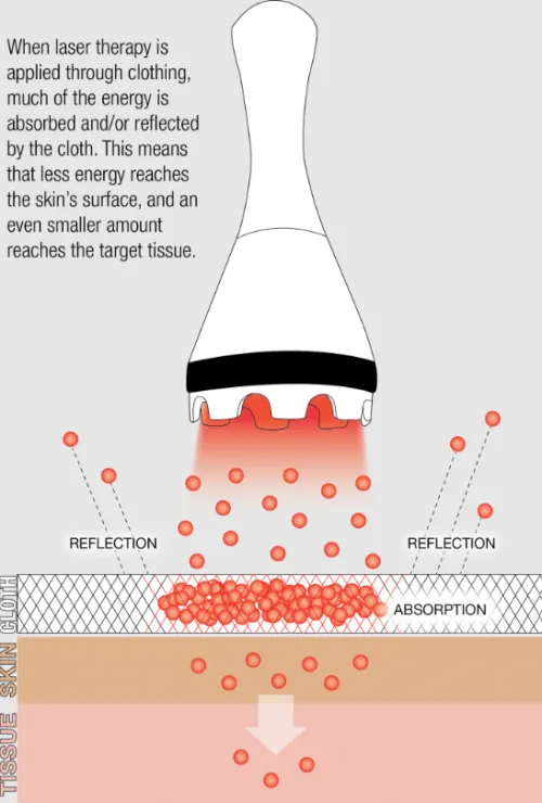 Laser Therapy through Clothing